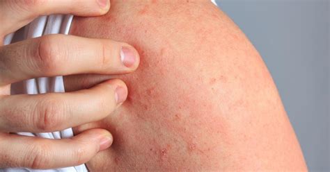 Scabies Rash: Treatment, Symptoms, Bites & How to Get Rid