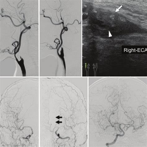 Preoperative Right Carotid Angiogram In The Lateral View A Showing A Download Scientific