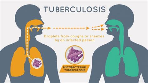 What Is Tuberculosis Whatmaster