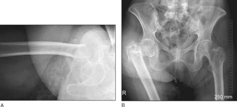 20 Intertrochanteric Hip Fractures Musculoskeletal Key