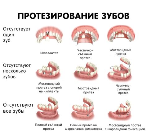 Виды Съемных Протезов Зубов Их Стоимость Фото Telegraph