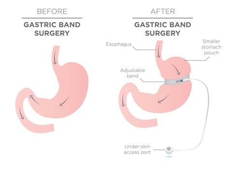 Gastric Band vs Gastric Sleeve Surgery - LILD