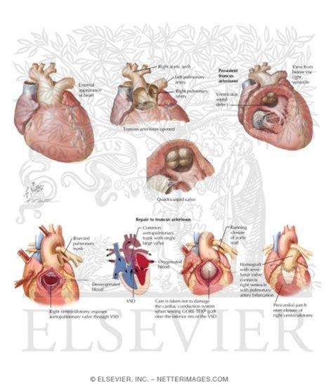 Truncus Arteriosus Communis