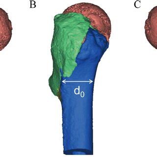 Illustration of 3D model of a pertrochanteric fracture after ...