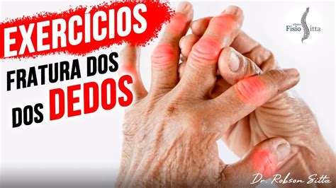 EXERCÍCIOS PARA OS DEDOS DA MÃO APÓS FRATURA DAS FALANGES Clínica de