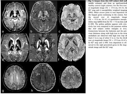 Intracranial Iron Distribution And Quantification In Aceruloplasminemia