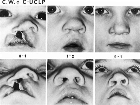 One Of The Patients With Pronounced Preoperative Nose Deformity Download Scientific Diagram