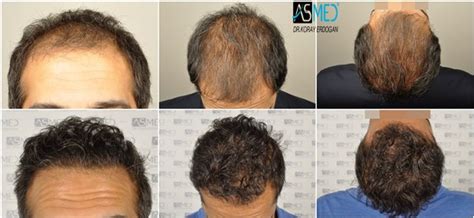 Norwood 6 Hair Transplantation Results Asmed Hair Transplant