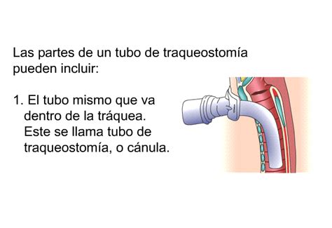 Cuidados De La Traqueostomía Pediatría