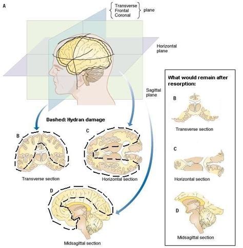 Information Rays Of Sunshine Hydranencephaly Support And Information