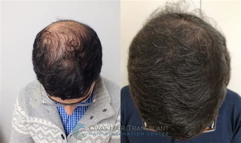 Civas Hair Transplant Fue Hair Transplant Before And After Pictures