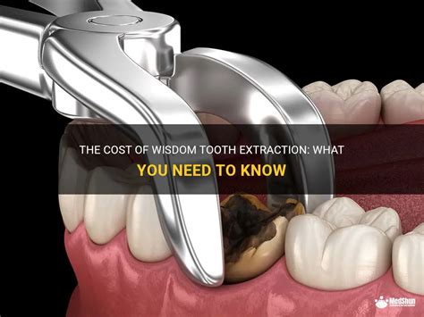 The Cost Of Wisdom Tooth Extraction What You Need To Know Medshun