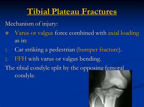 Bumper Fracture