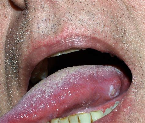 Tongue Cancer