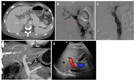 Agitation Thrombolysis Combined With Catheter Directed Thrombolysis For