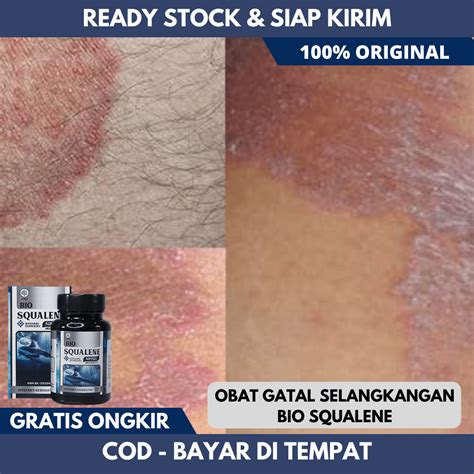 Celah Peha Gatal Dan Kering 9 Ubat Krim Gatal Terbaik 2022 Kulit