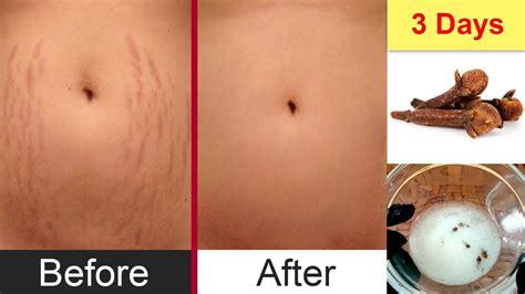 Remove Stretch Marks In 3 Days Get Rid With Home Remedies Naturally