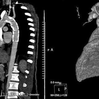 A Follow Up Computed Tomography Angiography At One Month Showing The