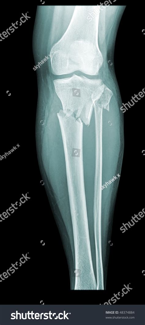 Broken Knee Xray Front View Stock Photo 48374884 - Shutterstock