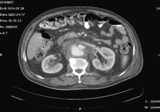 CT scan revealing 9.6cm infrarenal abdominal aortic aneurysm ...