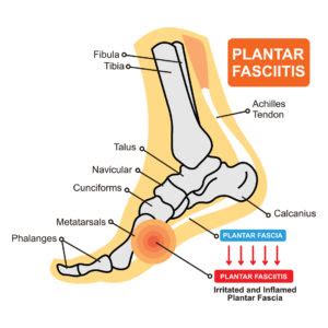 How to Wrap Your Foot for Plantar Fasciitis - Recommended Tips & Tricks