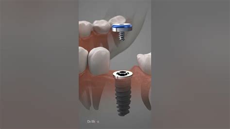 Dental Implant Procedure Youtube