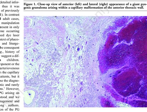 Microscopic Image Of The Giant Pyogenic Granuloma Taken Through A 25x