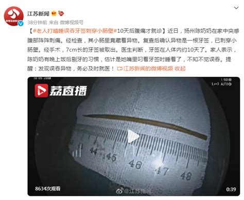 10天后腹痛才就诊！老人打瞌睡误吞牙签刺穿小肠壁