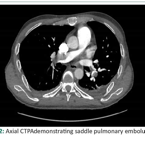 Transthoracic Echocardiogram Image Demonstrating Large Saddle Pulmonary Download Scientific