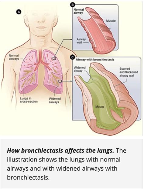 What Is Bronchiectasis In The Lungs Smartvest