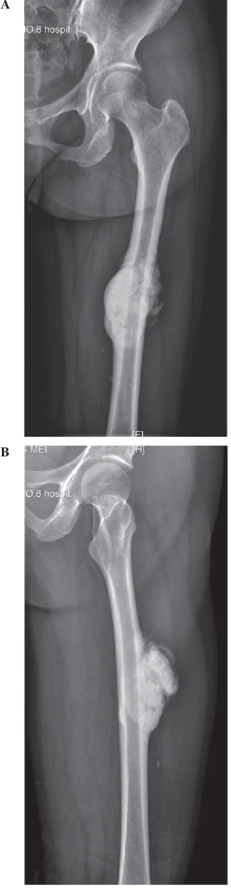 Figure 1 From Custom Made Intercalary Endoprosthetic Reconstruction For