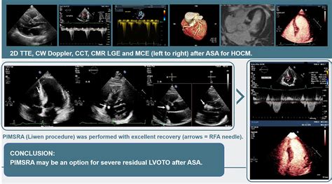 Percutaneous Intramyocardial Septal Radiofrequency Ablation Relieving