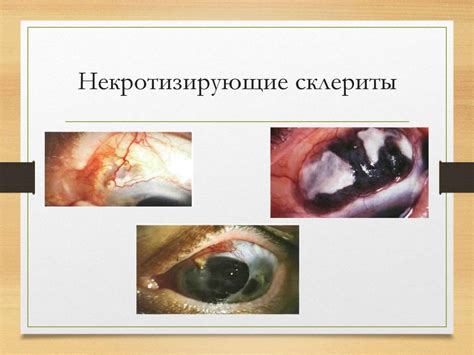 Эписклериты, склериты - презентация онлайн