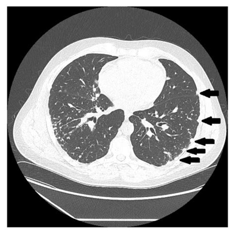 Chest CT Scan Of Granulomatous Lymphocytic Interstitial Lung Disease