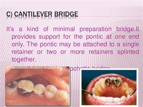 Types Of Crown And Bridges