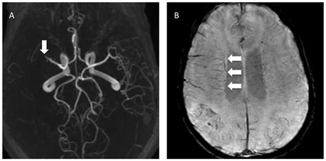 Middle Cerebral Artery Occlusion