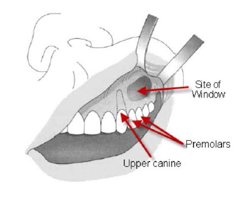 Caldwell Luc Approach