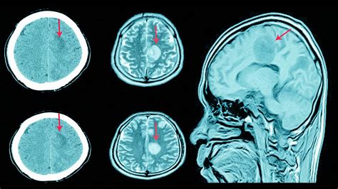 Hematoma Subdural Hematoma Causes Diagnosis Hematoma Treatment Themelower