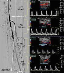 Duplex Ultrasound Assessment of Lower Extremity Arterial Disease ...