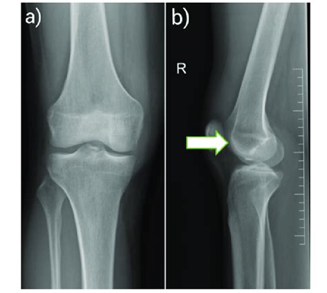 Plain Anteroposterior A And Lateral Radiographs B Of The Right Knee