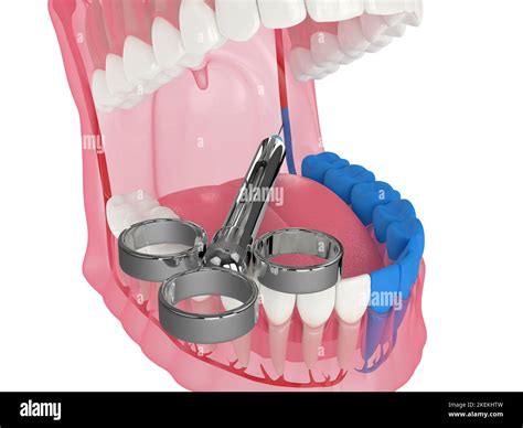 3d Render Of Human Jaw With Inferior Alveolar Nerve Block Technique