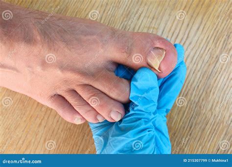 Ingrown Toenail Royalty Free Stock Photo CartoonDealer 211476105