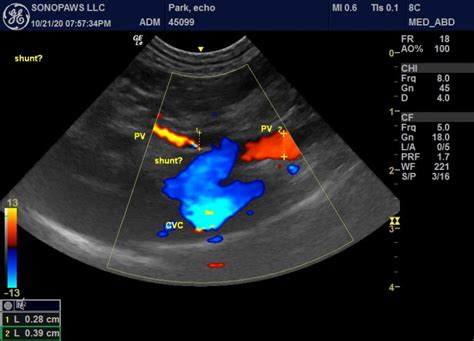 Extra-hepatic shunt? - Members