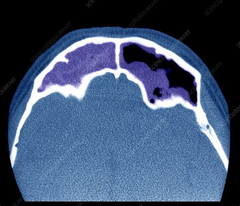 Frontal sinus infection, CT scan - Stock Image - C046/9125 - Science ...