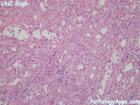 Adenomatoid Tumor Pathology