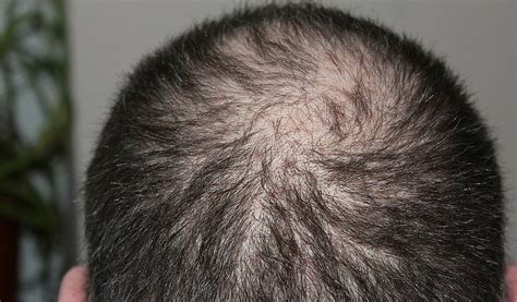 Is This Finally The Cure For Baldness Male Health Review