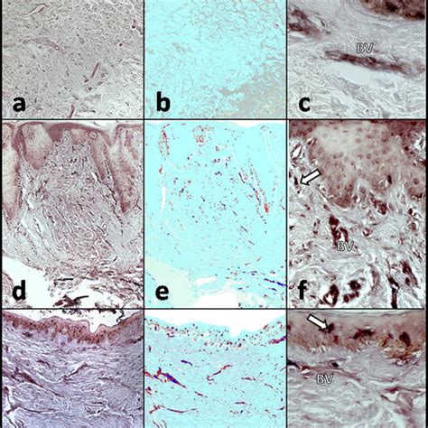 Protein Expression Of IL 1b In Hypertrophic Scar Tissue The Tissue