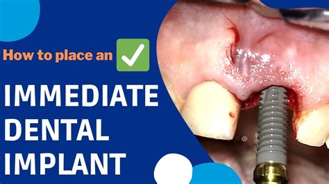 How Is An Immediate Dental Implant Surgery Done Implants Dental Clinic