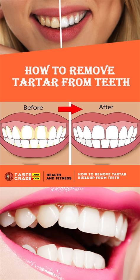 How To Remove Tartar From Teeth • TasteAndCraze