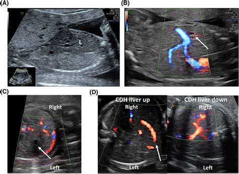 Congenital Diaphragmatic Hernia Ultrasound